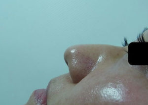 東京銀座のレティシアクリニック　鼻尖縮小　症例１-3