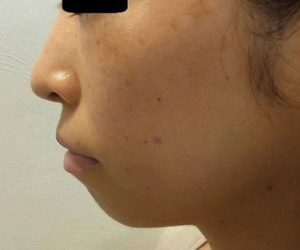 東京銀座のレティシアクリニック　鼻尖縮小　症例2-5