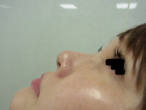 東京銀座のレティシアクリニック　鼻尖縮小　症例3-3
