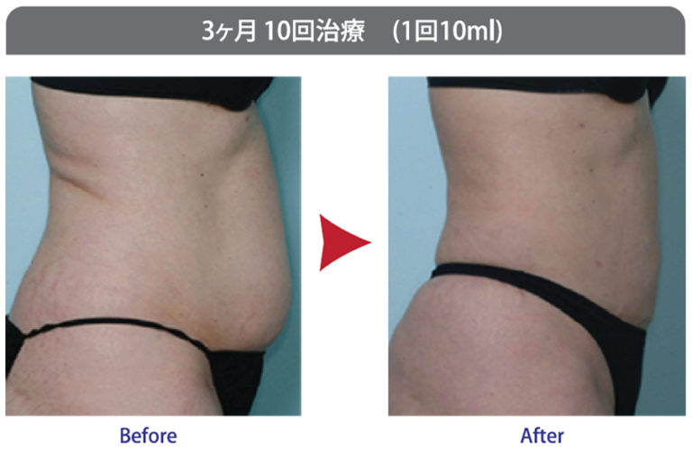 脂肪溶解注射 カベリン（kabelline) | 診療科目 | レティシア