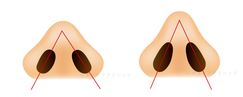 東京銀座のレティシアクリニック　鼻翼縮小術