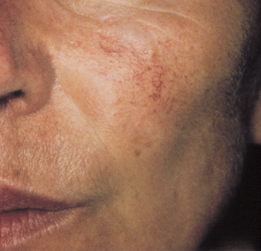 東京銀座のレティシアクリニック　VビームⅡ　赤ら顔症例