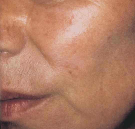 東京銀座のレティシアクリニック　VビームⅡ　赤ら顔症例