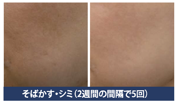 美容皮膚科　美容外科　東京銀座レティシアクリニック　水光注射オプション　KBOOSTER