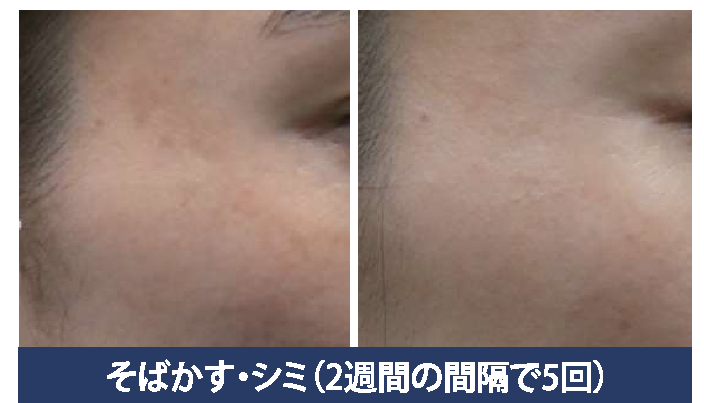 美容皮膚科　美容外科　東京銀座レティシアクリニック　水光注射オプション　KBOOSTER