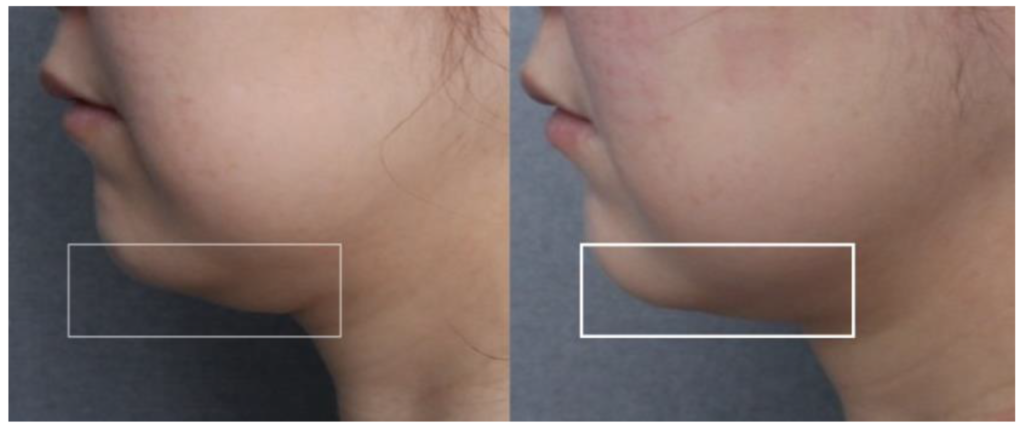 美容整形外科　美容皮膚科　銀座　レティシアクリニック 10THERA(テンセラ）たるみとシワの改善に