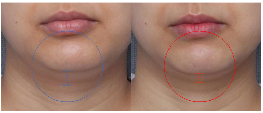 美容整形外科　美容皮膚科　銀座　レティシアクリニック 10THERA(テンセラ）たるみとシワの改善に