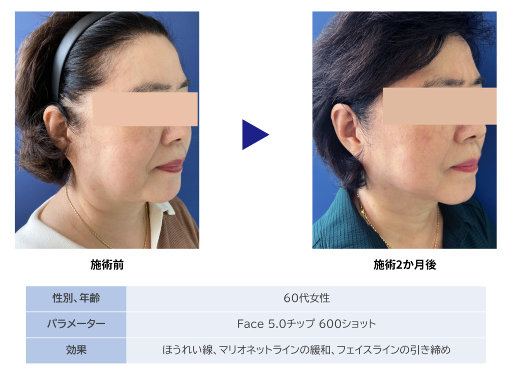 東京銀座　美容整形外科　美容皮膚科　レティシアクリニック　10THERMA テンサーマ
