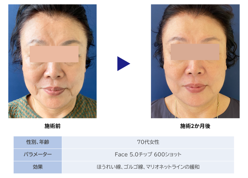 東京銀座　美容整形外科　美容皮膚科　レティシアクリニック　10THERMA テンサーマ
