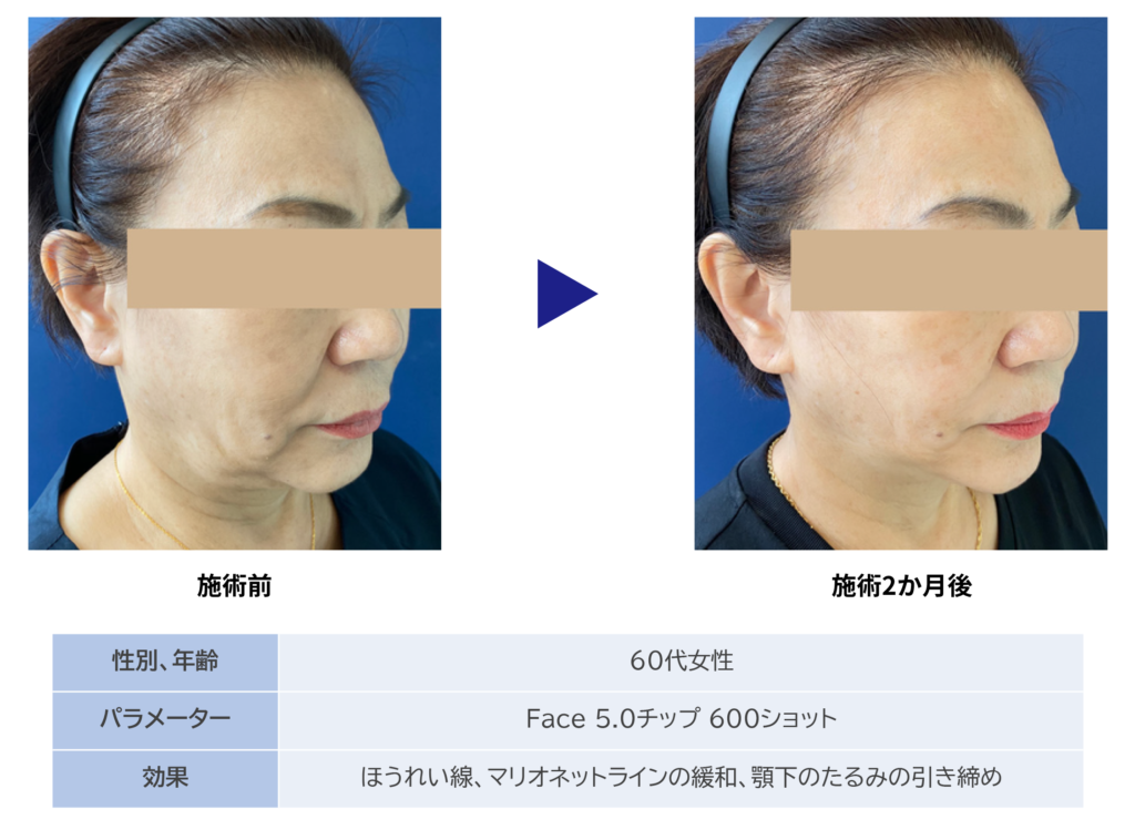 東京銀座　美容整形外科　美容皮膚科　レティシアクリニック　10THERMA テンサーマ
