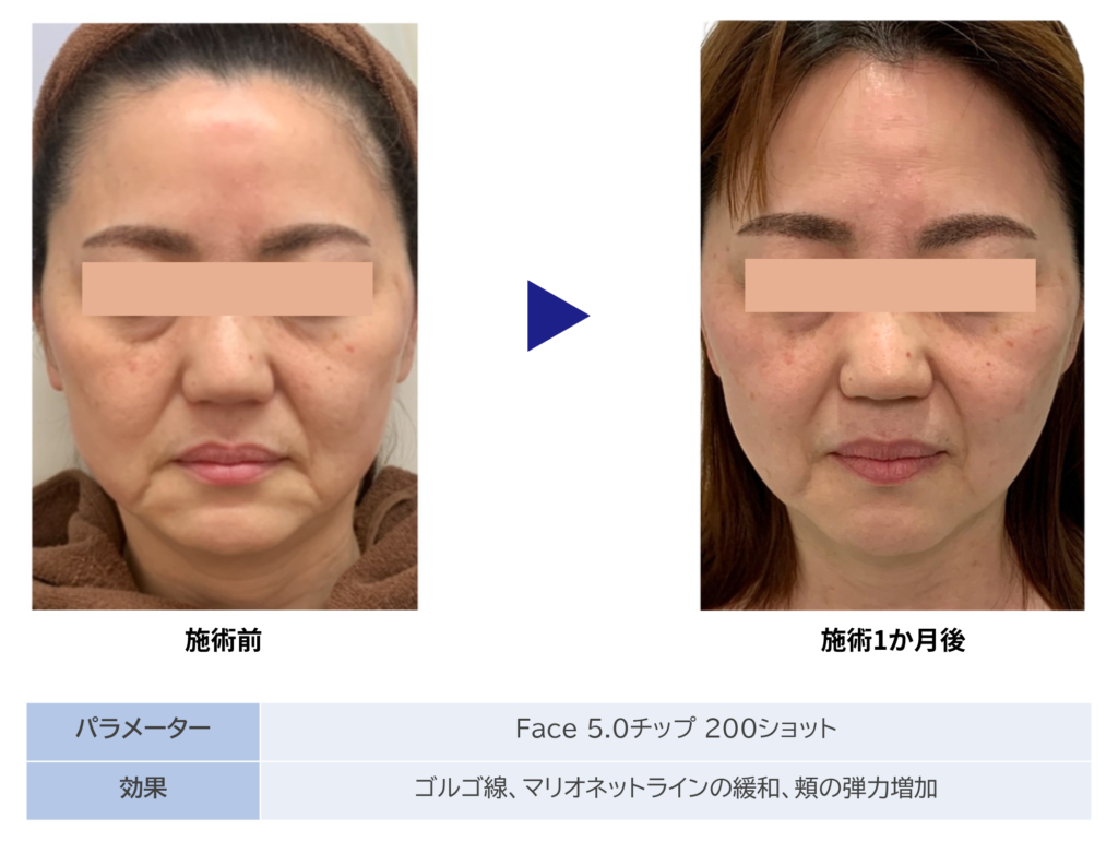 東京銀座　美容整形外科　美容皮膚科　レティシアクリニック　10THERMA テンサーマ
