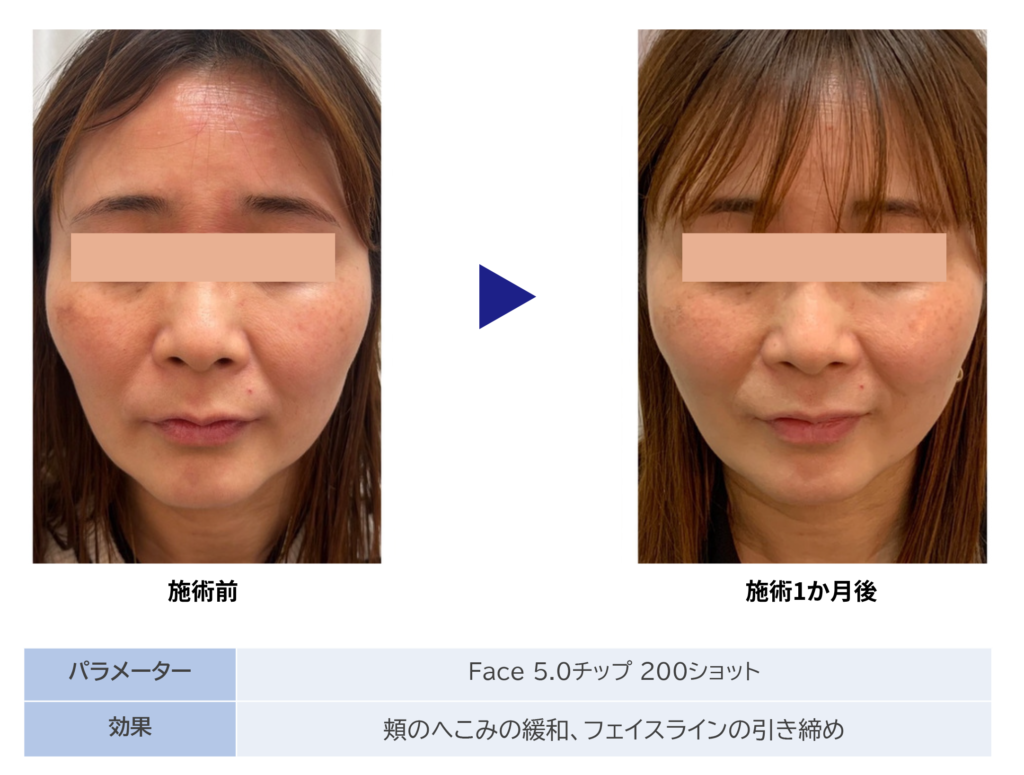 東京銀座　美容整形外科　美容皮膚科　レティシアクリニック　10THERMA テンサーマ
