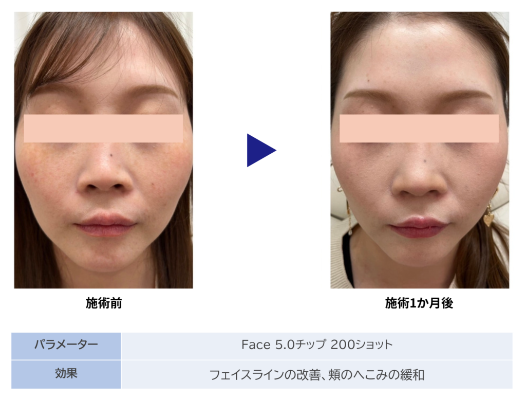 東京銀座　美容整形外科　美容皮膚科　レティシアクリニック　10THERMA テンサーマ
