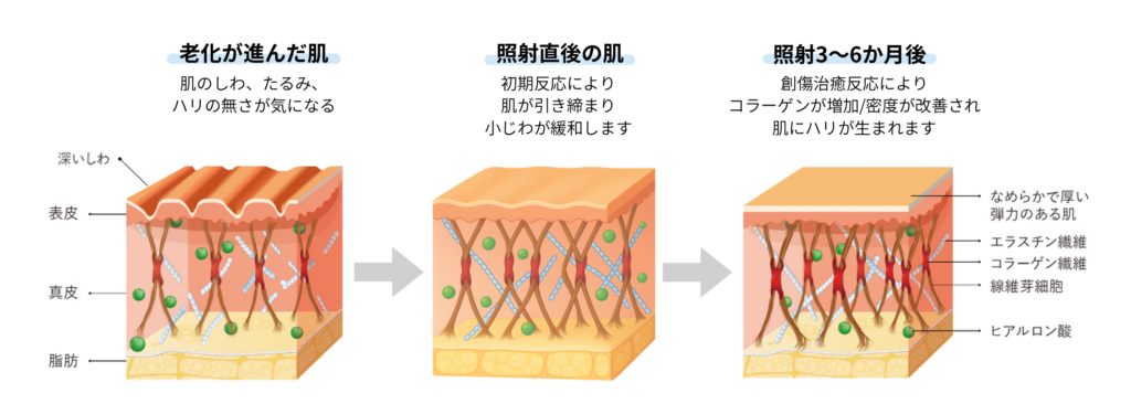 東京銀座　美容整形外科　美容皮膚科　レティシアクリニック　10THERMA テンサーマ
