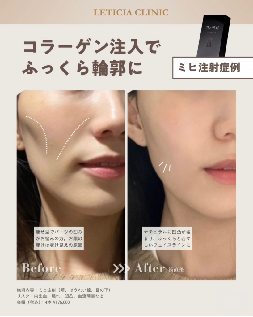 美容皮膚科　銀座レティシアクリニック　ミヒ注射　コラーゲン注入でふっくら輪郭に（頬、ほうれい線、目の下）