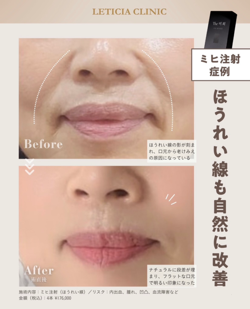美容皮膚科　銀座レティシアクリニック　ミヒ注射　ほうれい線も自然に改善（ほうれい線）