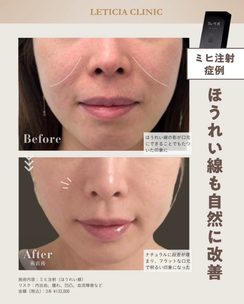 美容皮膚科　銀座レティシアクリニック　ミヒ注射　ほうれい線も自然に改善（ほうれい線）