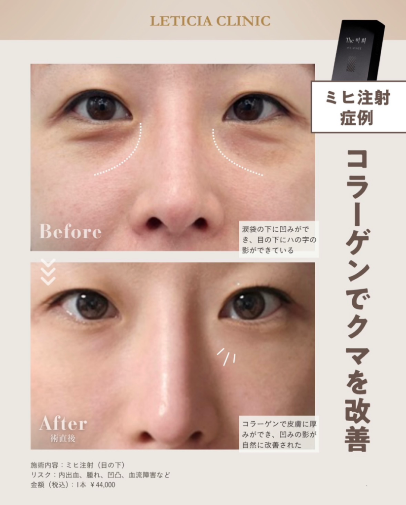 美容皮膚科　銀座レティシアクリニック　ミヒ注射　コラーゲンでクマを改善（目の下）