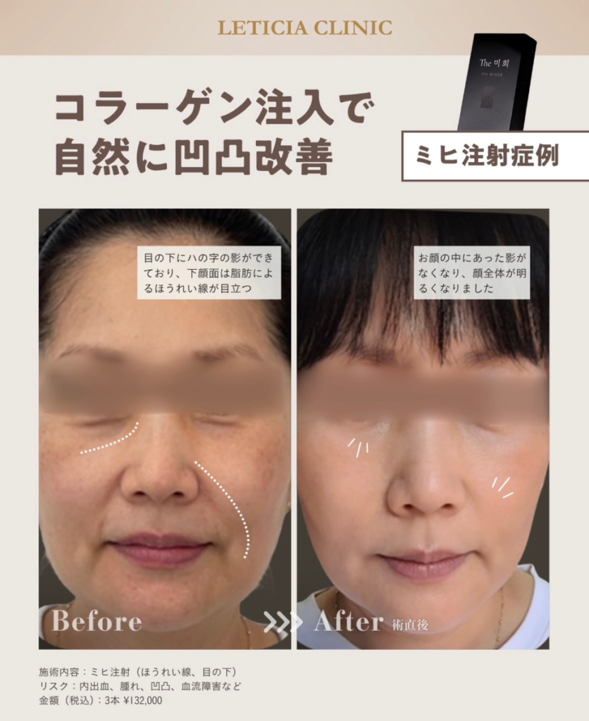 美容皮膚科　銀座レティシアクリニック　コラーゲン注入で自然に凹凸改善（ほうれい線・目の下）